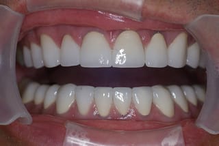 Before After Dental Case