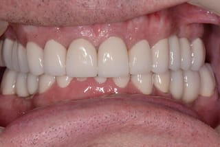 Before After Dental Case