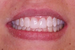 Before After Dental Case