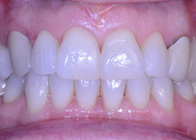 Before After Dental Case