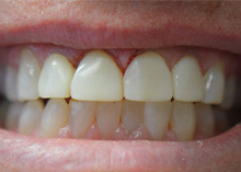 Before After Dental Case