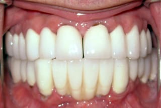 Before After Dental Case