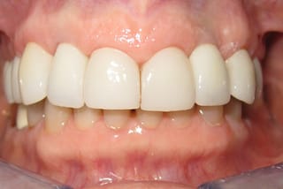 Before After Dental Case