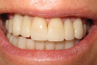 Before After Dental Case