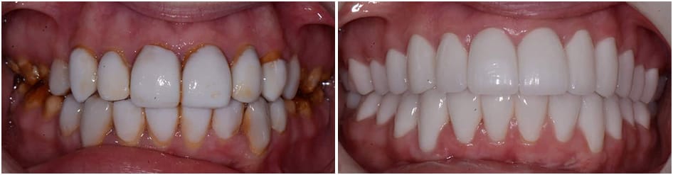 Slide 6 - teeth going from yellow and corroded to white