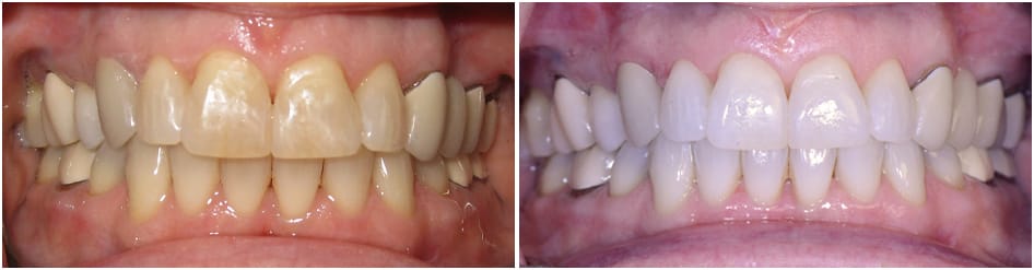 Slide 3 - caps not looking good, then after going to greider, looking better