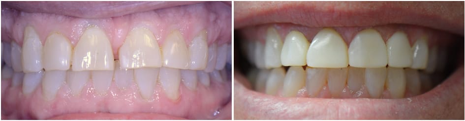 Slide 4 - teeth looking kind of shabby- teeth looking better after greider