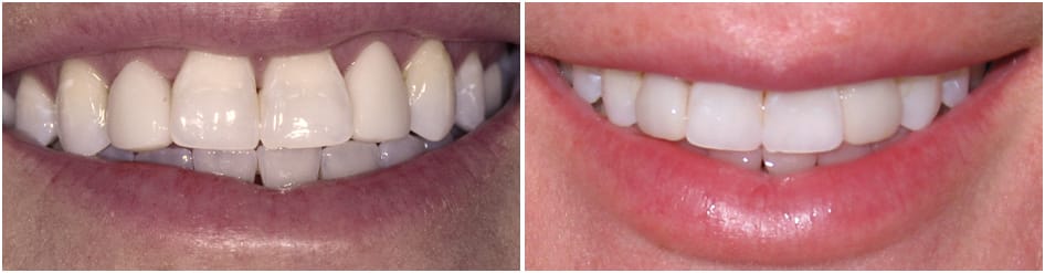 Slide 2 - A chipped tooth getting a veneer to cover it and make it look complete again